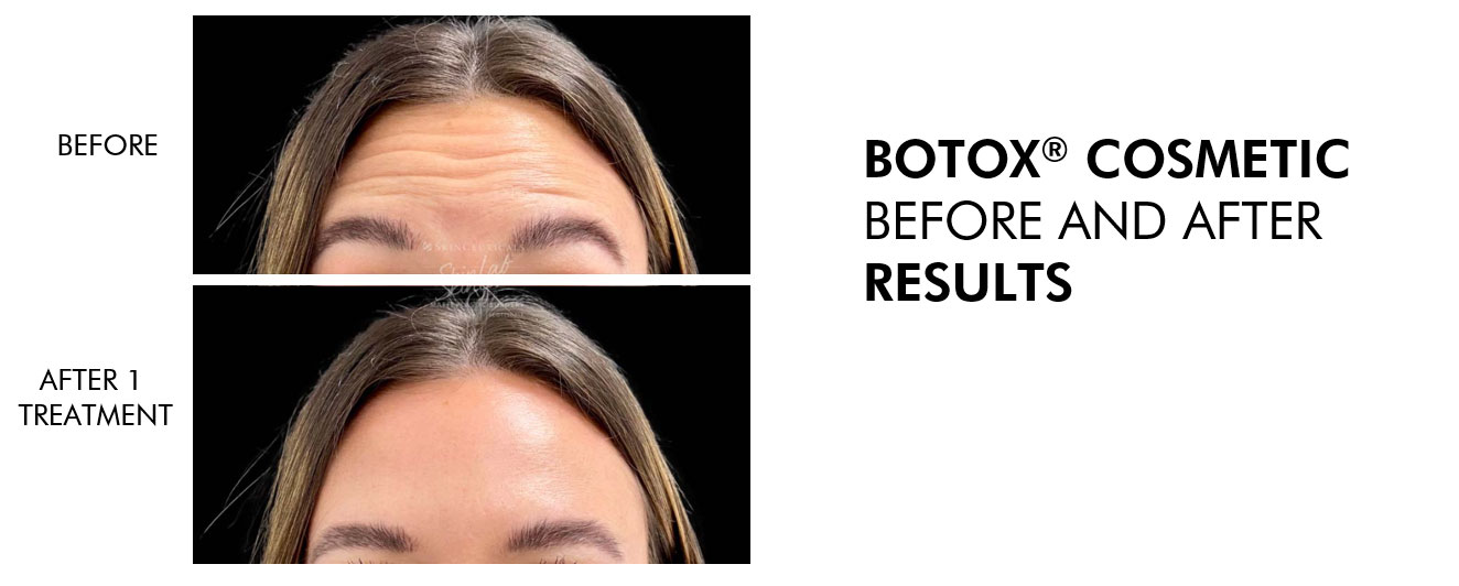 Botox Cosmetic Before and after